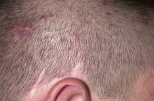 What are common types of folliculitis? - MedicineNet